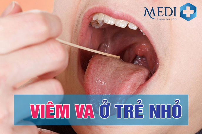 Viêm VA ở trẻ em: Dấu hiệu và biến chứng mãn tính