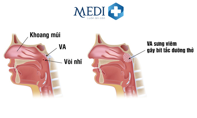 Viêm VA gây ảnh hưởng đến đường hô hấp của trẻ