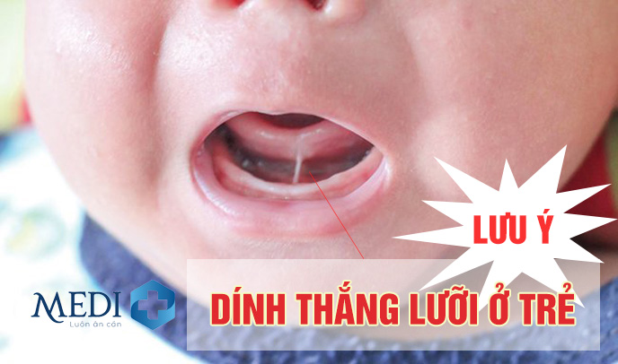 Dính thắng lưỡi ở trẻ: Cách nhận biết và điều trị