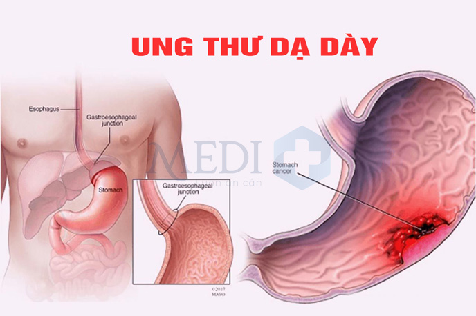 Ung thư dạ dày: Nguy hiểm tính mạng, dấu hiệu nào để nhận biết?