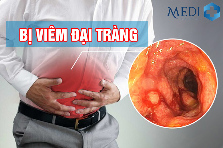 Viêm đại tràng: Nguyên nhân và các biến chứng nguy hiểm có thể xảy ra