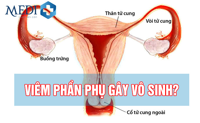 Viêm phần phụ biến chứng có thể gây vô sinh?