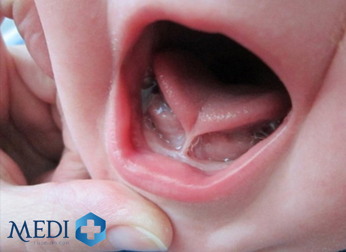 Dính thắng lưỡi là dị tật bẩm sinh nhẹ ở trẻ