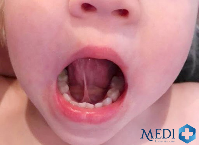 Dính thắng lưỡi có thể ảnh hưởng đến khả năng ngôn ngữ và ăn uống của trẻ 