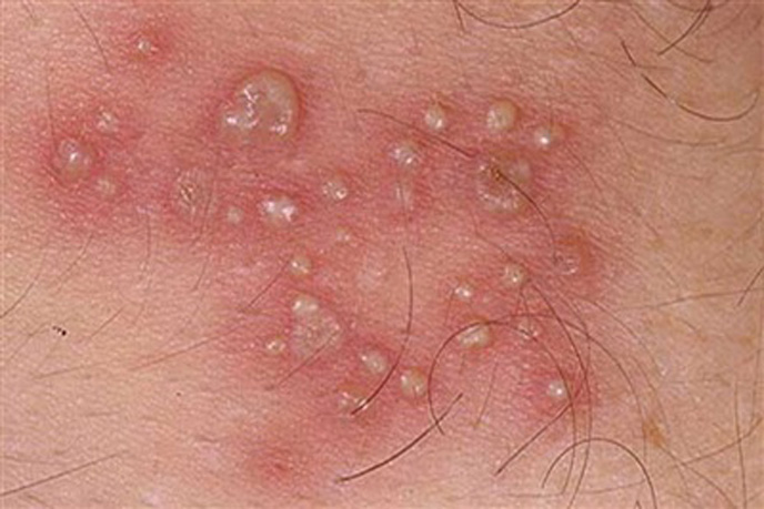 Hình ảnh bị herpes sinh dục với các nốt dạng mụn mủ nước