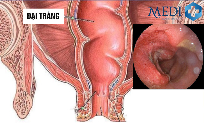 Viêm đại tràng kéo dài có thể gây ra nhiều biến chứng nguy hiểm ảnh hưởng sức khỏe