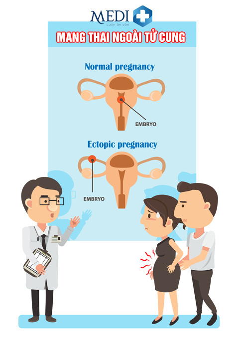 Mang thai ngoài tử cung do biến chứng viêm phần phụ gây ra