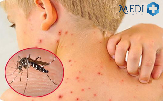Muỗi vằn là tác nhân trung gian truyền bệnh sốt xuất huyết ở trẻ