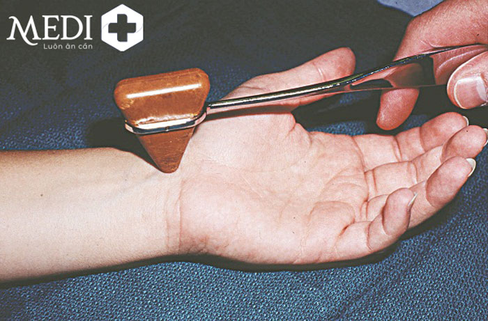 Nghiệm pháp Tinel giúp bác sĩ chẩn đoán mắc hội chứng ống cổ tay