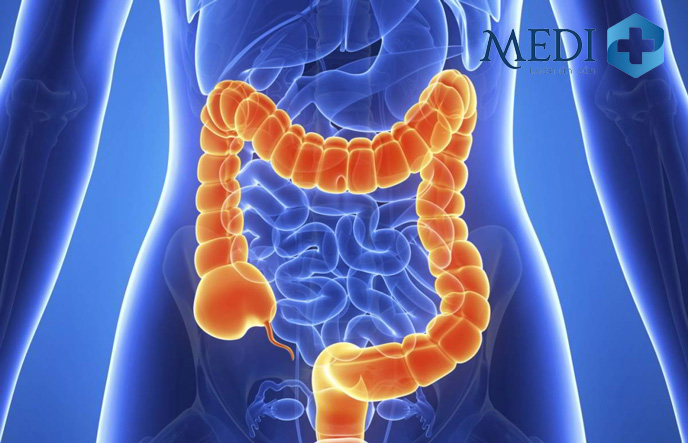 Megacolon - Đại tràng phình to ra là một trong những biến chứng nghiêm trọng