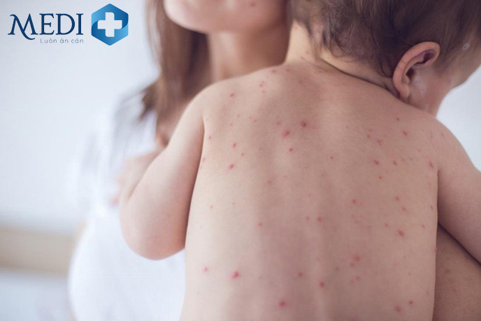 Trẻ bị sốt phát ban có nên tắm không, tắm lá gì?