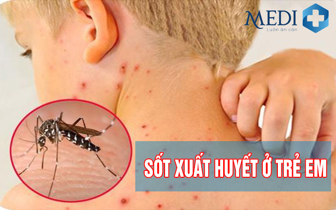 Sốt xuất huyết ở trẻ em: Sai lầm khiến trẻ nguy kịch