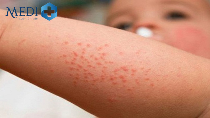 Trẻ xuất hiện ban đỏ trên da khi mắc sốt xuất huyết