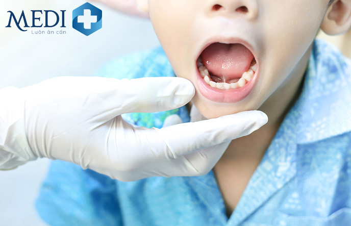 Tùy theo mức độ dính thắng lưỡi mà bác sĩ sẽ đưa ra hướng điều trị khác nhau 