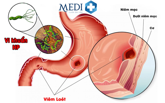 Nhiễm vi khuẩn HP làm tăng nguy cơ ung thư dạ dày