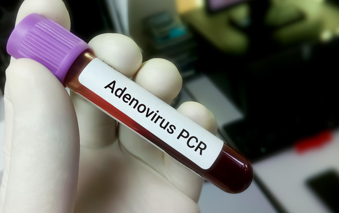 Xét nghiệm Adenovirus PCR xác định chính xác sự có mặt của virus adeno