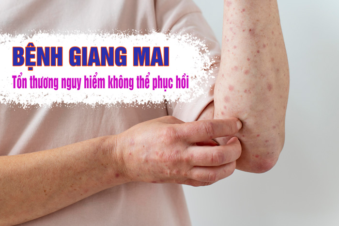 Bệnh giang mai chiếm tỷ lệ cao các ca bệnh lây nhiễm qua đường tình dục