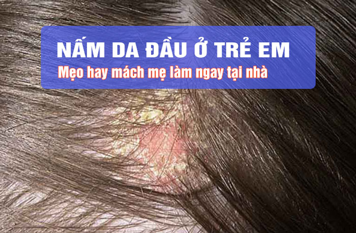 Bị nấm da đầu phải làm sao Cách xử lý nấm da đầu hiệu quả