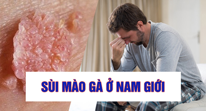 Bệnh sùi mào gà ở nam giới do virus và dễ lây lan nếu không có biện pháp phòng tránh