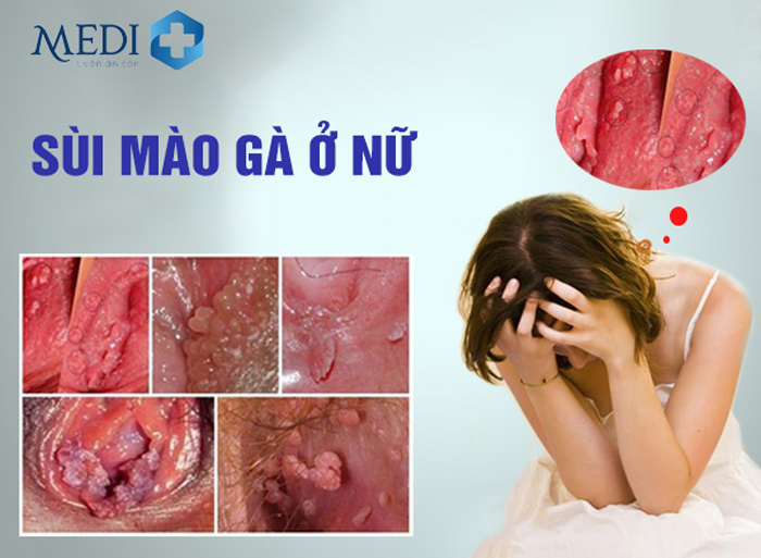 Bệnh sùi mào gà ở nữ dễ mắc và nhiều biến chứng sau này