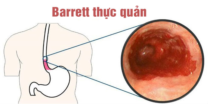 Barrett thực quản (Barrett's esophagus)