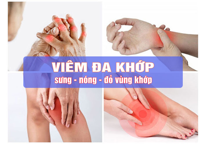 Viêm đa khớp là gì? Cách giảm đau và điều trị hiệu quả