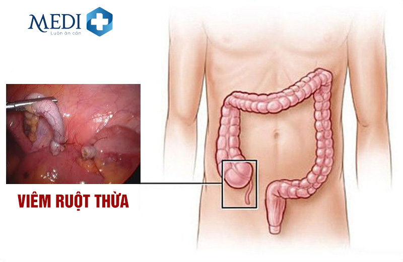 Viêm ruột thừa và Phương pháp điều trị dứt điểm