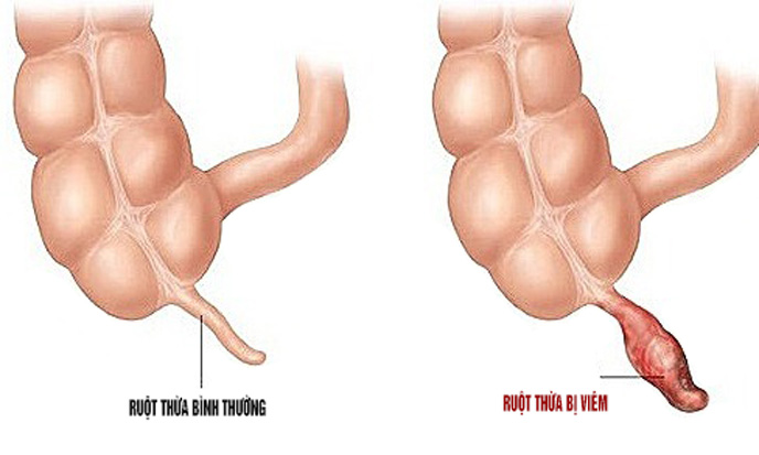 Bị viêm ruột thừa do tắc nghẽn phân, dịch ruột và các vi khuẩn gây viêm