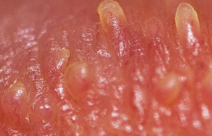 Các nốt sùi mào gà trên da do virus HPV gây ra