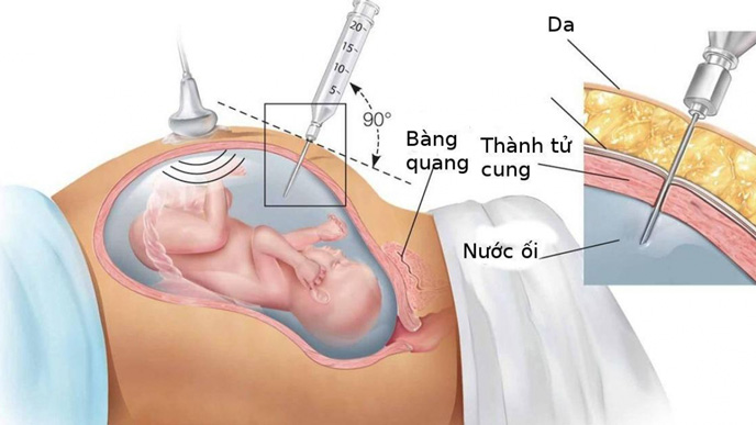 Chọc hút nước ối mang đi xét nghiệm