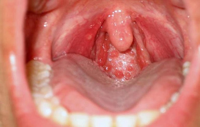 Ung thư vòm họng xuất phát từ vùng tế bào vảy tăng sinh không kiểm soát