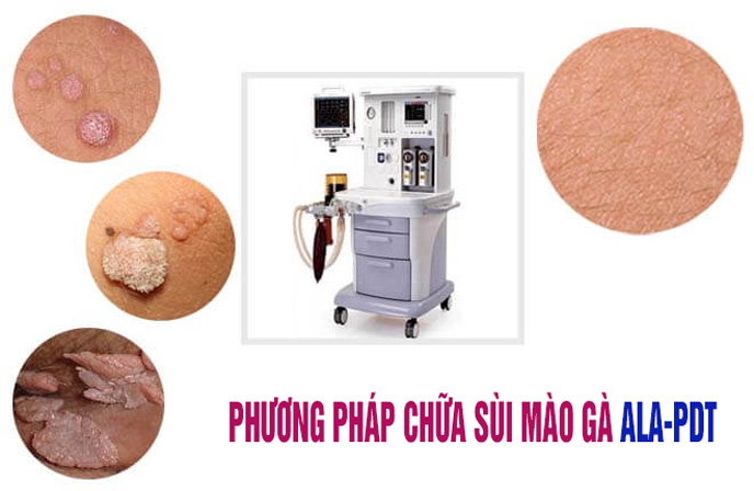 Phương pháp chữa sùi mào gà ALA-PDT sử dụng ánh sáng huỳnh quang