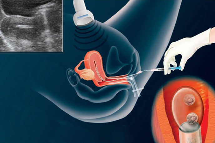 Chuyển phôi vào buồng trứng khi đủ điều kiện phôi phát triển