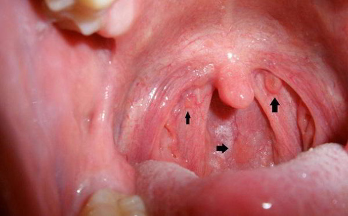 Ung thư vòm họng được chia làm 5 giai đoạn phát triển
