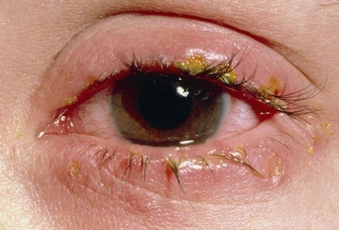 Hình ảnh bệnh giang mai ở mắt và nguy cơ biến chứng mù lòa