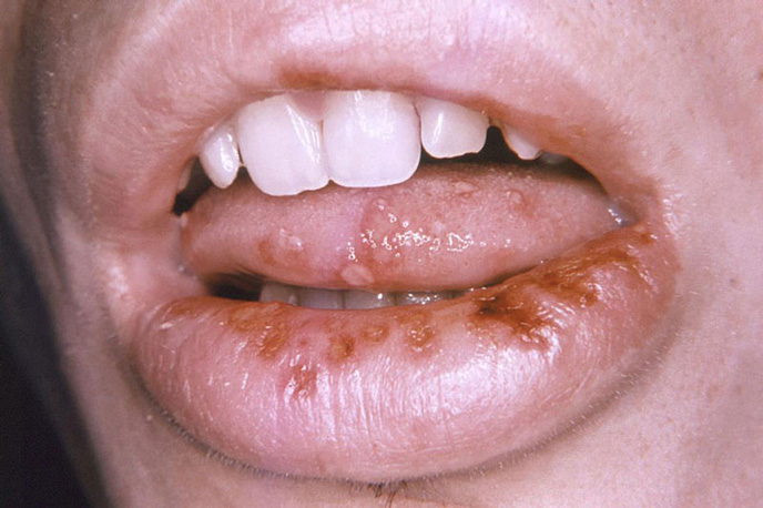 Hình ảnh bệnh giang mai ở miệng lưỡi với các vết viêm loét