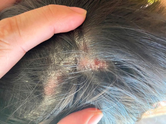 Nấm da đầu thường gặp ở trẻ tè 5-10 tuổi
