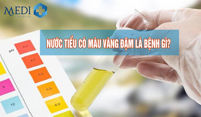 Nước tiểu màu vàng đậm – Nhiều bệnh lý nguy hiểm tiềm ẩn