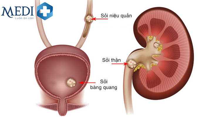 Bị viêm sỏi thận sỏi bóng đái khiến cho hiện tượng nhiễm trùng và tè rời khỏi máu