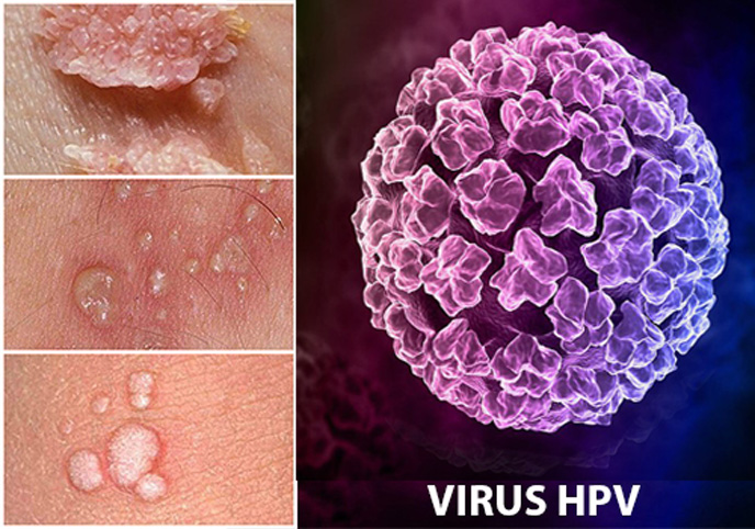 Sùi mào gà ở nam nguyên nhân do các chủng virus HPV