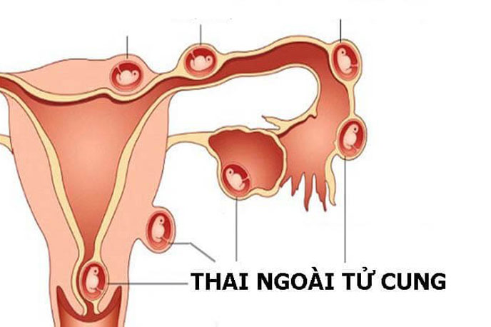 Vị trí thai ngoài tử cung có thể gặp phải khi thực hiện thụ tinh nhân tạo