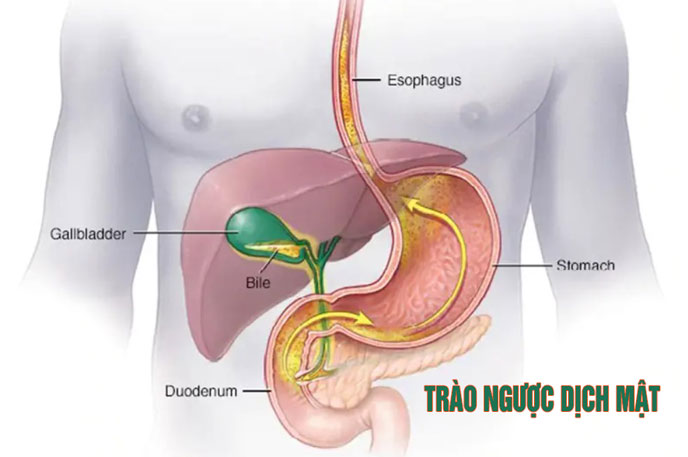 Trào ngược dịch mật, hậu quả khó lường