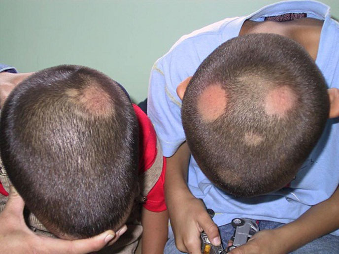 Da đầu xuất hiện các vòng tròn màu đỏ hoặc hồng (vết ban đỏ)