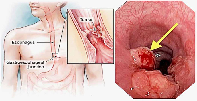 Ung thư thực quản một dạng biến chứng nguy hiểm do trào ngược dịch mật