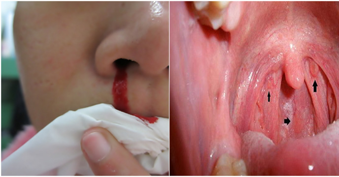 Nghẹt mũi, chảy máu cam cũng là những nhấu hiệu cảnh báo sớm bệnh ung thư vòm họng