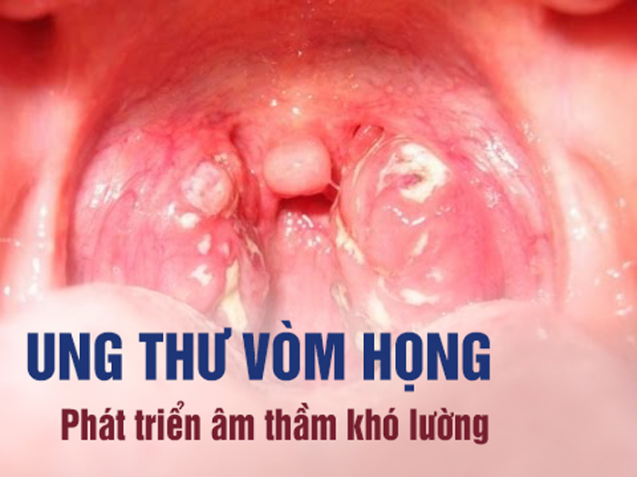 Ung thư vòm họng: Dấu hiệu nhận biết sớm để điều trị