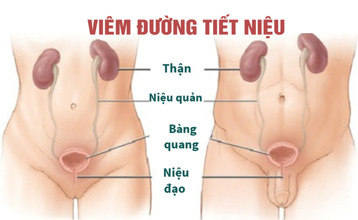 Viêm đường tiết niệu là gì? Có nguy hiểm, Dấu hiệu nhận biết