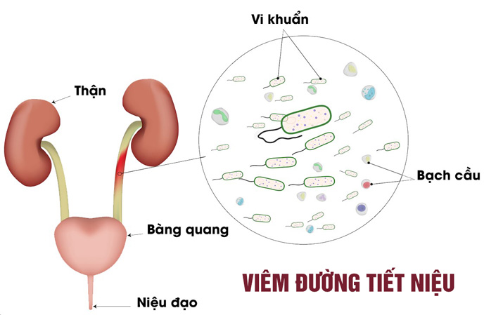 Viêm đường tiết niệu do vi khuẩn xâm nhập gây ra nhiễm trùng