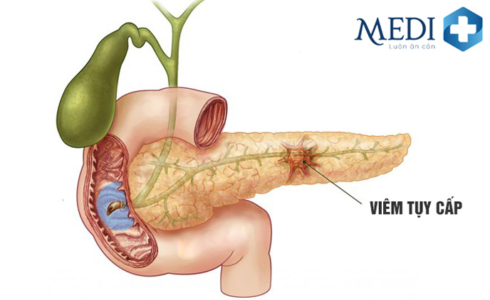 Bị viêm tụy cấp gây chướng bụng đầy hơi, nước tiểu chuyển màu