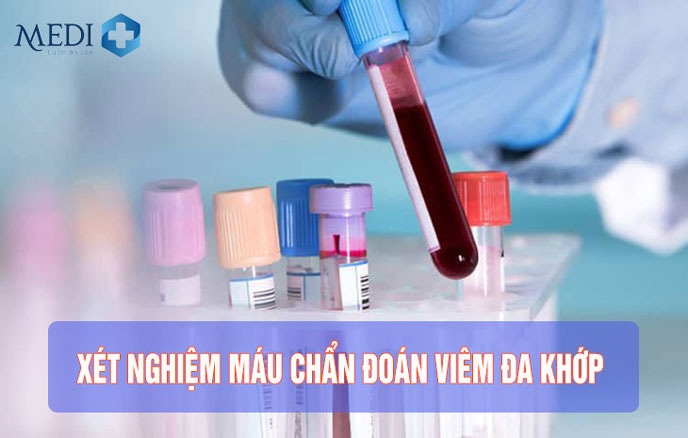 Cần làm xét nghiệm máu tìm virus xác định nguyên nhân viêm đa khớp